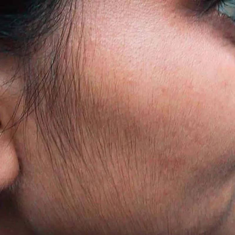 Hirsutizm nədir? Səbəbləri, əlamətləri və müalicəsi