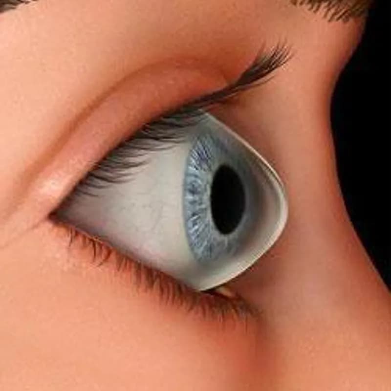 Keratokonus nədir? Əlamətləri, səbəbləri və müalicə üsulları